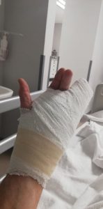 Hand surgery